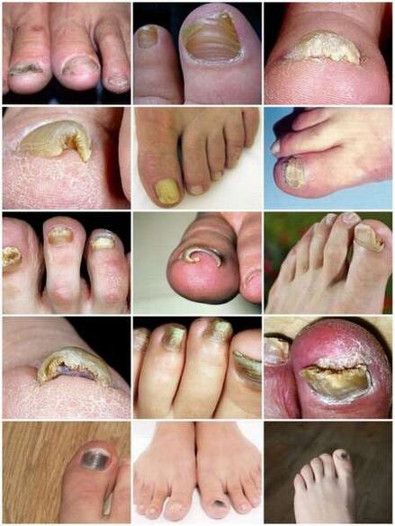 Gljivična infekcija ploče nokta