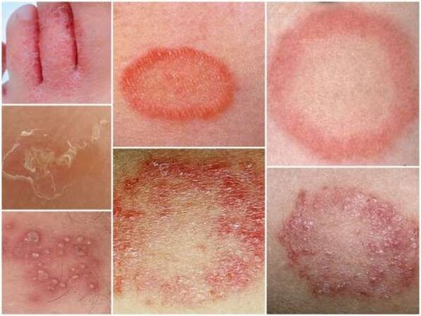 Trichophytosis kože nogu