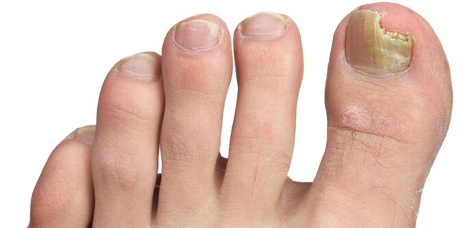 gljivična infekcija ploče nokta